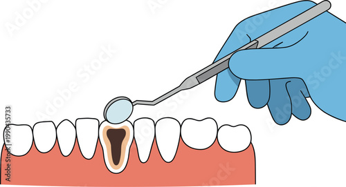 Dental examination illustration showing tooth decay inspection with mirror and dentist tool
