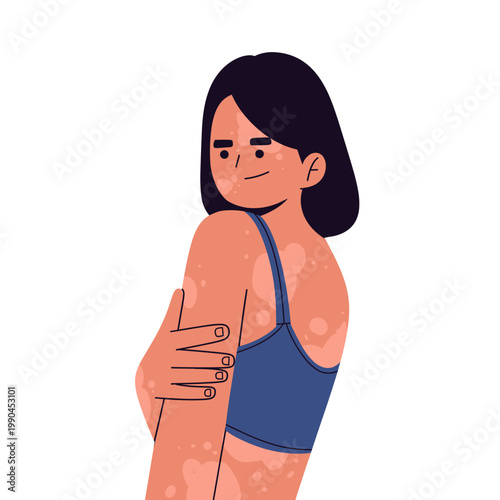 Flat illustration of people with vitiligo showing diverse skin conditions and body positivity. Ideal for health, identity, equality concepts, diversity, dermatology awareness empowerment.