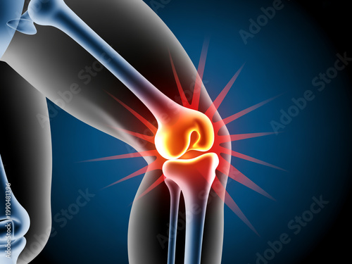 Illustration of knee joint inflammation and pain radiating outward