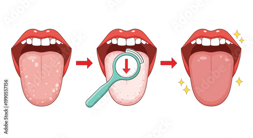 Tongue scraper dental hygiene infographic, oral care routine for cleaning white coating, medical vector illustration of healthy mouth and tongue