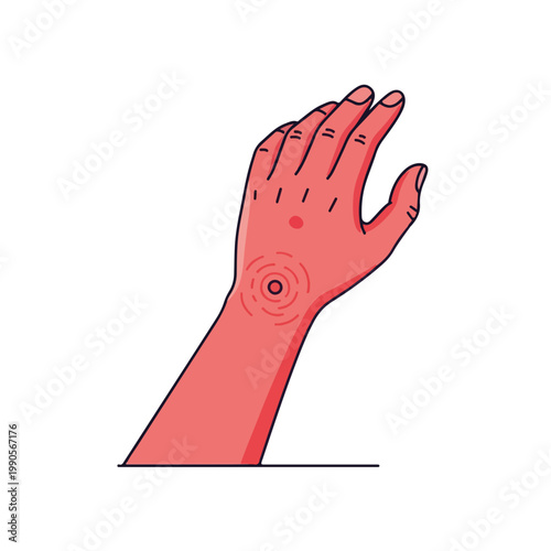 Human hand with skin rash or irritation. Flat design medical symptom graphic. Allergy or insect bite concept isolated on white background