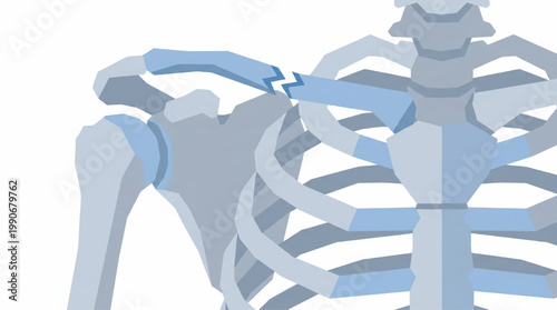 Illustration of a fractured human clavicle bone
