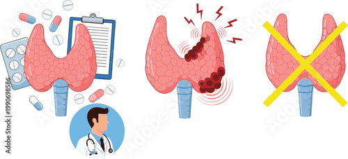Thyroid Gland Disorder Illustration Set Showing Healthy, Diseased, and Treated Conditions with Medication and Doctor for Medical Education, Healthcare Design, and Endocrine System Graphics