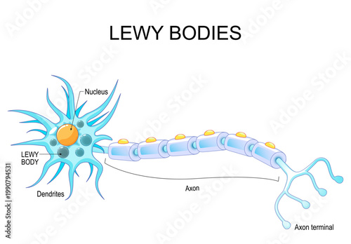 Neuron with Lewy bodies. Neurodegeneration, neuroinflammation, and parkinsons disease