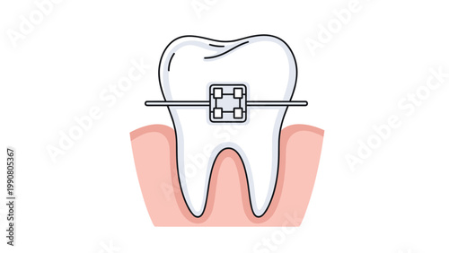 Detailed illustration of a human tooth with dental braces highlights the necessary process of orthodontic treatment and oral care.