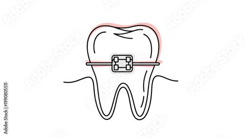 Simple vector illustration of a molar tooth with dental braces and a pink gum line on a clean white background for medical use.