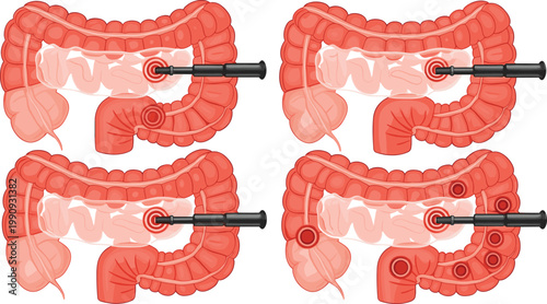 Colonoscopy Procedure Illustration Set Showing Large Intestine Examination with Endoscope, Medical Diagnostic Process, Digestive System Healthcare Vector Diagram Collection