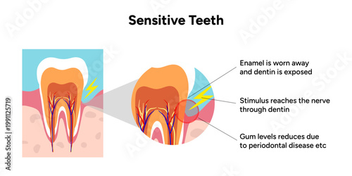 Hand-drawn illustration of tooth sensitivity anatomy in educational style. Tooth structure, exposed dentin, enamel wear, and nerve pathways that cause sensitivity 