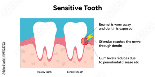 Hand-drawn illustration of tooth sensitivity anatomy in educational style. Tooth structure, exposed dentin, enamel wear, and nerve pathways that cause sensitivity 