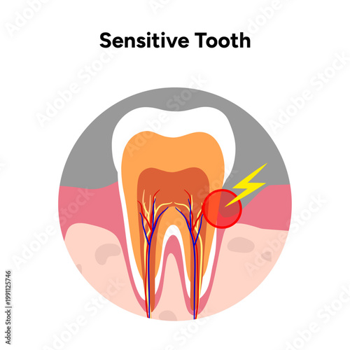 Hand-drawn illustration of tooth sensitivity anatomy in educational style. Tooth structure, exposed dentin, enamel wear, and nerve pathways that cause sensitivity 