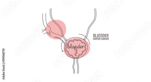 Illustration of the urinary system showing the bladder with cancerous tumors, representing bladder cancer