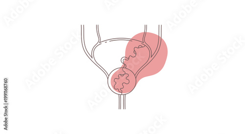 An illustrated representation of the urinary system, highlighting an area of concern within the bladder structure