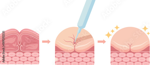 Medical infographic vector showing skin layers with needle injection for dermal fillers anti aging treatment and collagen restoration procedure for dermatology and beauty healthcare clinic marketing