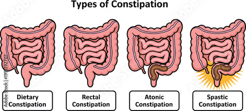Medical infographic vector illustrating types of constipation including dietary rectal atonic and spastic conditions for gastroenterology education digestive health awareness 