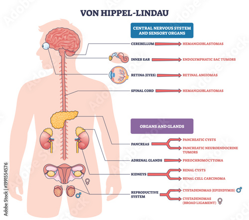 Von Hippel Lindau syndrome map shows tumor sites in brain, retina, kidneys, and pancreas, noting hemangioblastomas and renal cell carcinoma. Key, brain, kidneys, pancreas. Outline diagram
