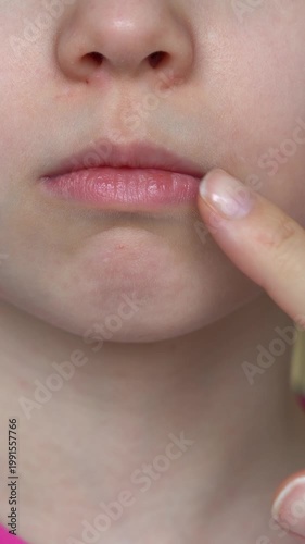 Mothers hand applies ointment to mouth of child with angular stomatitis. Close up of girls face with perleche. Angulit. Vertical shot