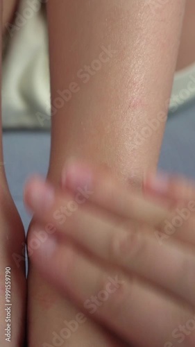 Hand applies ointment to child legs with rash and allergy. Diathesis atopic dermatitis on body. Vertical shot