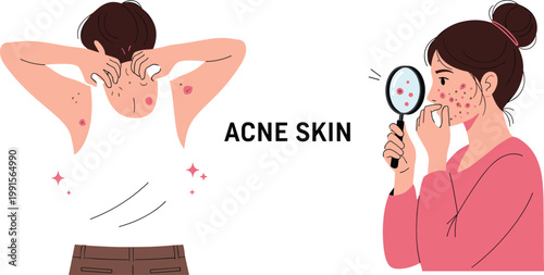 Acne skin problem concept illustration with young woman squeezing pimples and checking face in mirror dermatology skincare treatment and beauty issues.