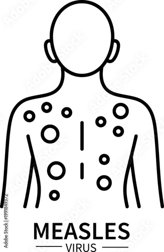 Illustration of measles virus rash on a human torso