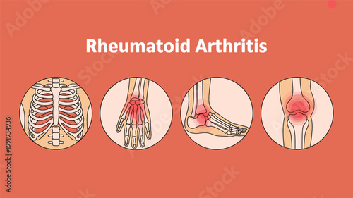Medical of rheumatoid arthritis in hand, wrist, knee, and foot joints