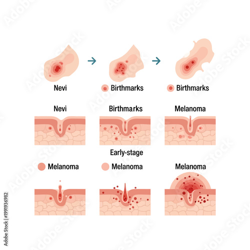 Illustration showing the progression of skin conditions from nevi and birthmarks to early-stage and advanced melanoma, with surface and cross-sectional views.