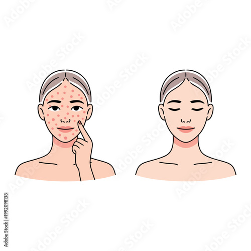An illustration of a woman with acne and a clear face side by side