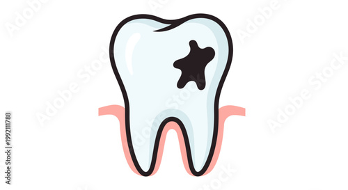 Tooth Decay Vector Illustration, Dental Caries Icon with Cavity in Flat Graphic Style for Oral Health and Dentistry Education