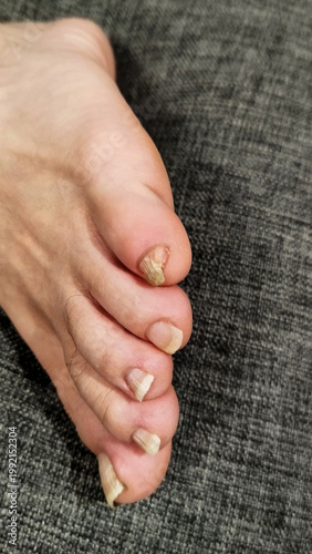 Foot rests on a gray surface, showing toes and toenail conditions in clear light