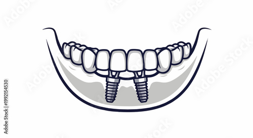 A stylized illustration of a lower jaw with two dental implants supporting several teeth