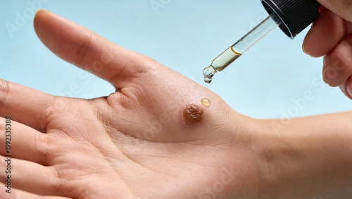 A close-up of a hand with a skin blemish. A dropper bottle is dispensing liquid onto the blemish. The background is light blue, creating a clinical atmosphere.