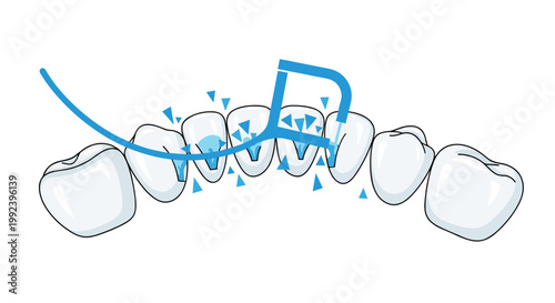 A detailed medical diagram illustrates the use of a blue dental floss pick to remove plaque and debris from between white teeth under bright and clear lighting.
