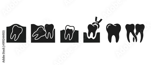 Dental Tooth Extraction Process Icons Set, Wisdom Tooth Surgery and Oral Care Treatment Vector Illustration, Stomatology Medical Procedure Stages for Clinic Information or Patient Education Graphics.