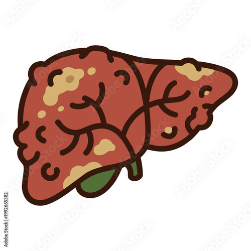 Liver Disease Cirrhosis and Hepatic Inflammation Illustration