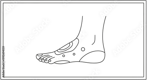 Foot pain diagram, plantar fasciitis, arch pain, heel pain, medical illustration
