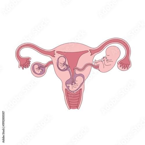 Illustration depicting various stages and locations of human fetal development within the uterus and fallopian tubes, including ectopic pregnancies.