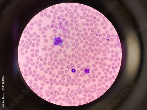 Atypical mononuclear cells or virocytes in a blood smear under light microscope for diagnosis 