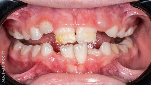 Local hypoplasia of the central permanent incisors in a child.	