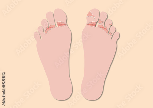 Athlete's foot infection, illustration