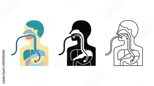 Nasogastric tube feeding medical illustration showing tube placement in digestive system.