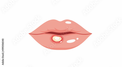 Close-up of pink lips with a prominent red-bordered blister on the lower lip