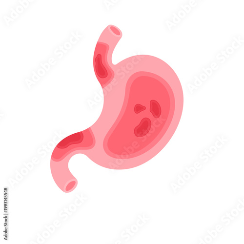 Peptic Ulcer Disease illustration 
