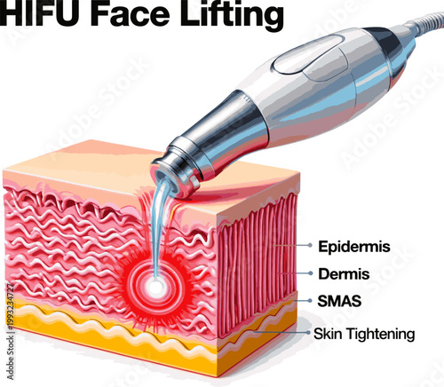 Isolated a realistic HIFU face lifting laser shot on skin for skin tightening. 3D rendering vector art with white background. vector art with white background..