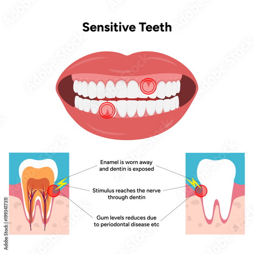 Hand-drawn illustration of tooth sensitivity with visual examples teeth. Educational enamel wear, exposed dentin, and reaction to hot and cold stimuli. causes of tooth sensitivity and oral discomfort