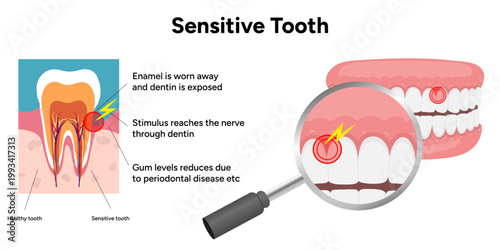 Hand-drawn illustration of tooth sensitivity with visual examples teeth. Educational enamel wear, exposed dentin, and reaction to hot and cold stimuli. causes of tooth sensitivity and oral discomfort