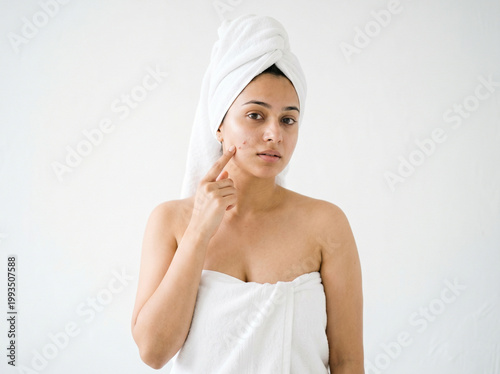 young woman with towel touching cheek showing pimple isolated on white background representing acne treatment skincare routine and natural beauty concept