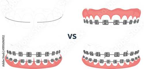 Dental Braces and Clear Aligner Comparison Set with Upper and Lower Jaw for Orthodontic, Dentistry, and Oral Health Care DesignsDental Braces and Clear Aligner Comparison Set with Upper 