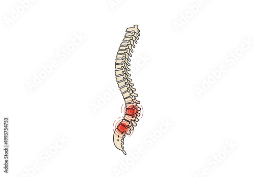 Human spine anatomy illustration with red inflammation highlighting lower back pain and spinal disc injury isolated on white background