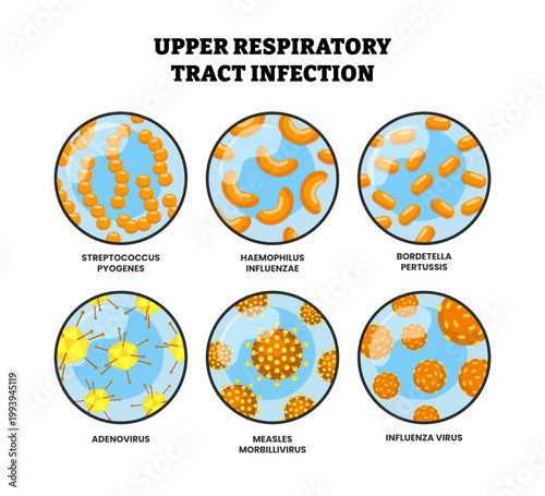 Different types of upper respiratory tract infection types. Labeled adenovirus, measles morbillivirus, influenza. tonsillitis, nasal obstruction, sore throat, pharyngitis, laryngitis, and sinusitis
