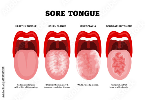 Different types of sore tongue types set collection. Labeled healthy tongue, lichen planus,leukoplakia geographic tongue.Red patches, pink tongue coating, inflammatory disease, white raised patches.