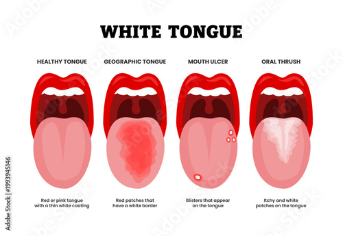 Different types of white tongue types set collection. Labeled healthy, geographic tongue, mouth ulcer and oral thrush. Red patches, blisters, itchy and white coating vector illustration.